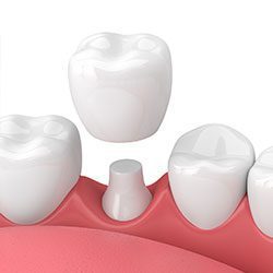 Dental crowns