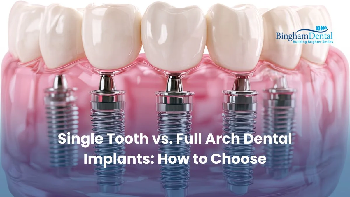 Single Tooth vs. Full Arch Dental Implants