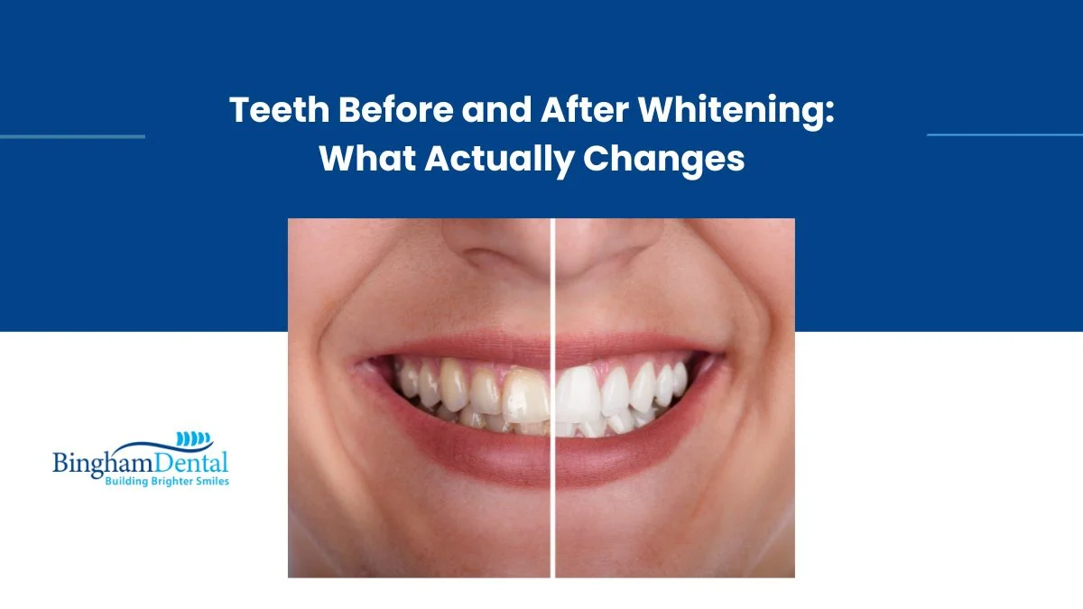Teeth Before and After Whitening: What Actually Changes